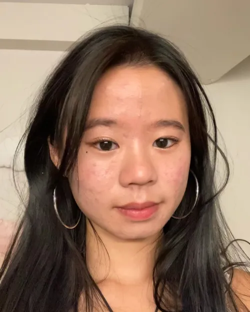 AI Blemish Remover